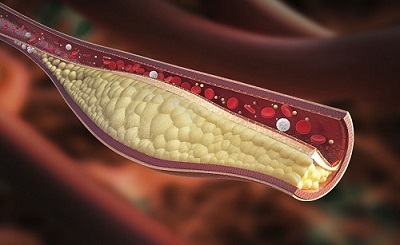 img-dislipidemia